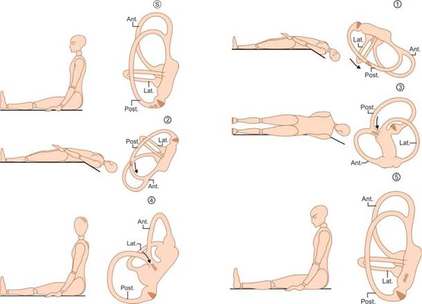 Vertigine parossistica posizionale benigna e posizionale Vertigo Varianti