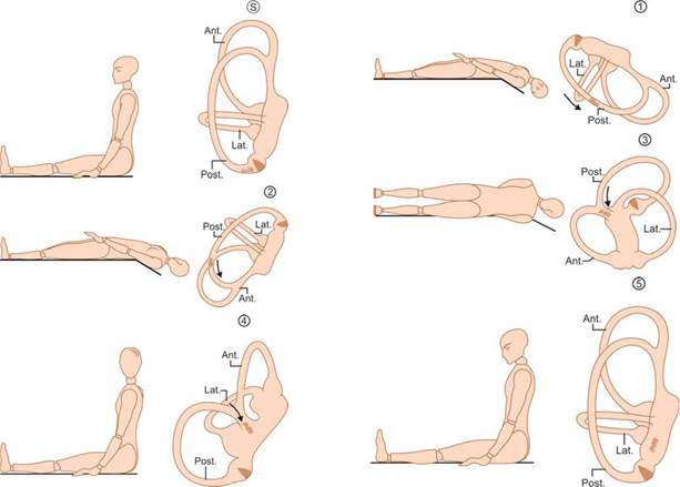 Vertigine parossistica posizionale benigna e posizionale Vertigo Varianti