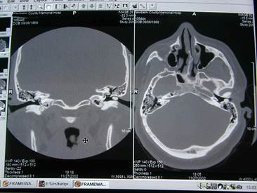 http://radiology.med.sc.edu/eac%20osteoma.jpg
