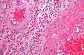http://upload.wikimedia.org/wikipedia/commons/1/17/Churg-Strauss_syndrome_-_very_high_mag.jpg