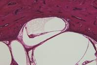 SEROUS LABYRINTHITIS