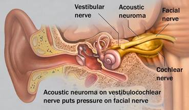 http://www.anac.ca/sites/default/files/acoustic-neuroma-3col.jpg
