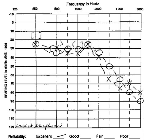 http://www.dizziness-and-balance.com/disorders/tumors/images/audiogram%20acoustic%20symmetrical%20hearing.jpg
