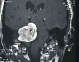 http://www.dizziness-and-balance.com/disorders/tumors/images/acoustic%20large.jpg