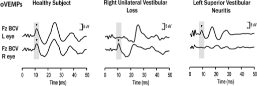 oVEMP responses for a healthy subject (left panel), a patient with right unilateral vestibular loss (middle panel), and a patient with left superior vestibular neuritis (right panel). The yellow bars mark the time of healthy oVEMP and n10 responses, respectively. The healthy subject displays n10 responses of similar magnitude beneath both eyes. The patient with right unilateral vestibular loss has normal n10 responses beneath the right (ipsilesional) eye, but no n10 responses beneath the left (contralesional) eye. These results are consistent with complete loss of otolithic function on the left side. The patient with left superior vestibular neuritis shows no oVEMPs beneath the right (contralesional) eye, but a normal oVEMP response beneath the left (ipsilesional) eye. This is consistent with oVEMPs being a predominantly utricular response. (Modified from Iwasaki et al. 2008, with permission 14).