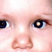 http://2.bp.blogspot.com/_uiyskjNZYt8/TG8izQB7SEI/AAAAAAAAB-w/Kqv8dR9XLMk/s320/Leukocoria.jpg