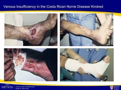 http://image.slidesharecdn.com/rehmphenotype-090909160500-phpapp02/95/understanding-and-expanding-the-phenotype-in-norrie-disease-3-728.jpg?cb=1252961124