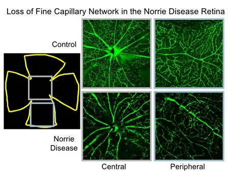 http://image.slidesharecdn.com/rehmphenotype-090909160500-phpapp02/95/understanding-and-expanding-the-phenotype-in-norrie-disease-5-728.jpg?cb=1252961124