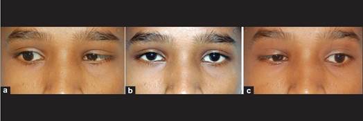 http://www.ijo.in/articles/2010/58/4/images/IndianJOphthalmol_2010_58_4_323_64120_u3.jpg
