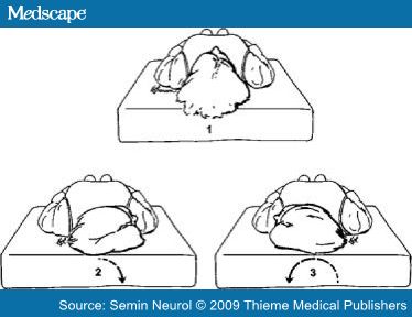 http://img.medscape.com/article/714/335/714335-fig4.jpg