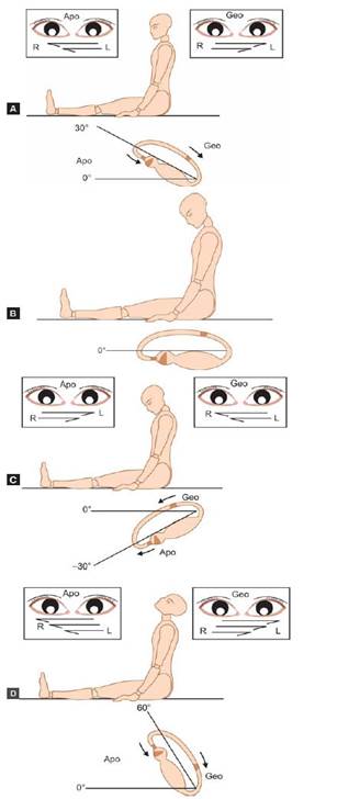 Vertigine parossistica posizionale benigna e posizionale Vertigo Varianti
