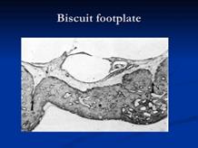 Biscuit footplate 