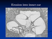 Erosion into inner ear 