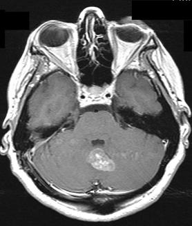 http://www.dizziness-and-balance.com/disorders/central/cerebellar/images/axial-vermis%20dysmetria.jpg